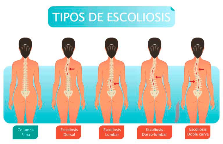 cirujanos especialistas en Escoliosis Moron Villa Lynch San Justo