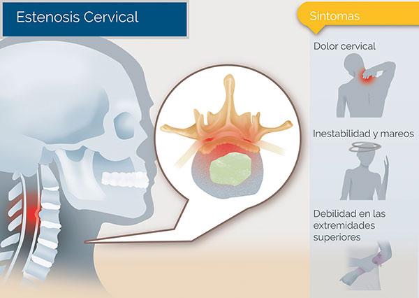 medicos especialistas en estenosis cervical zona oeste