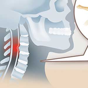 medico cirugía estenosis cervical zona oeste