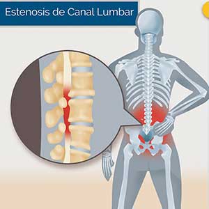 medico cirugía estenosis lumbar zona oeste