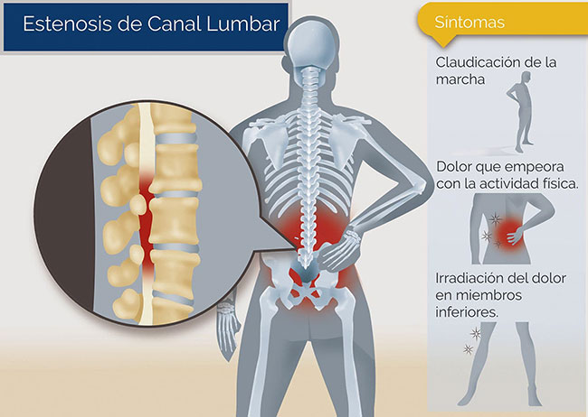 medicos cirujanos especialistas en estenosis lumbar zona oeste