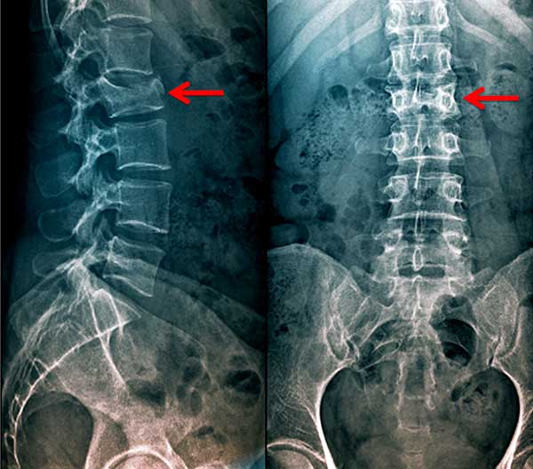 medicos cirujanos de columna vertebral fracturas zona oeste