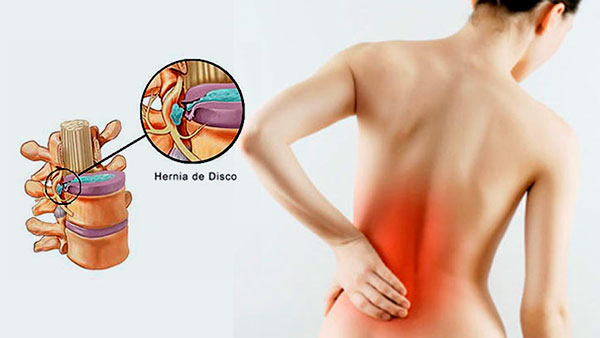 hernia de disco lumbar especialistas zona oeste