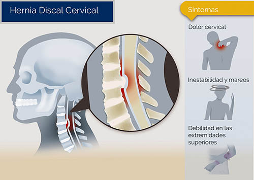hernia de disco cervical especialistas zona oeste