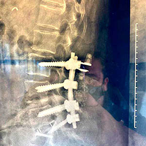 medico especialista en cirugía de columna zona oeste