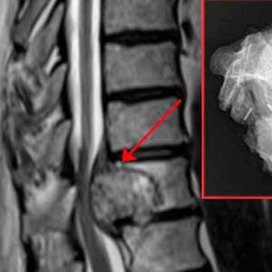 medico especialista en tumores de columna vertebral