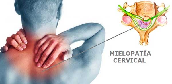 mielopatia cervical especialistas zona oeste