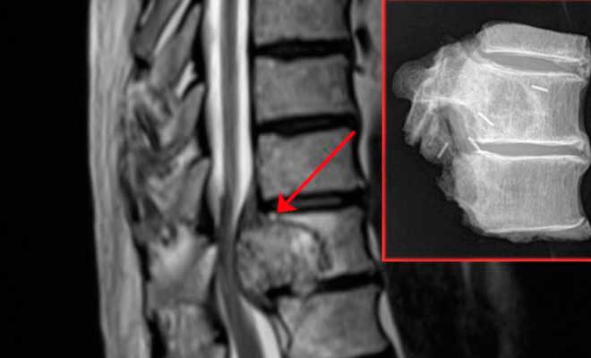 cirujano especialista en tumores de columna vertebral zona oeste